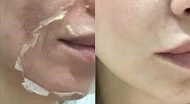 TCA (Trichloroacetic Acid)