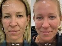 Micro Needling For Face