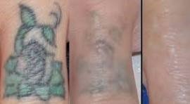 Laser Tattoo Removal 